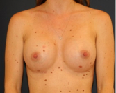 Feel Beautiful - Breast Augmentation 143 - After Photo